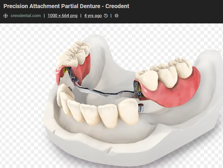 <ul><li><p>clasp assembly: provides retention by engaging undercuts of teeth </p></li><li><p>attachment: connect removable prostheses to natural teeth or implants</p></li></ul><p></p>