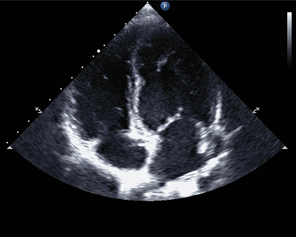 <p>an ultrasound of the heart</p>