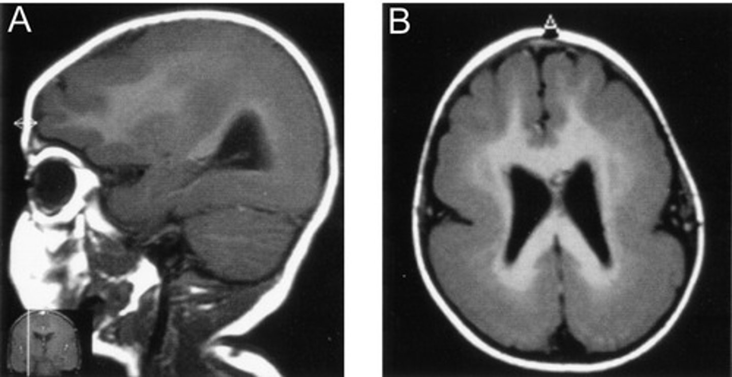 <p>A rare brain malformation where the brain's surface lacks the normal ridges and grooves; also known as "smooth brain"</p>