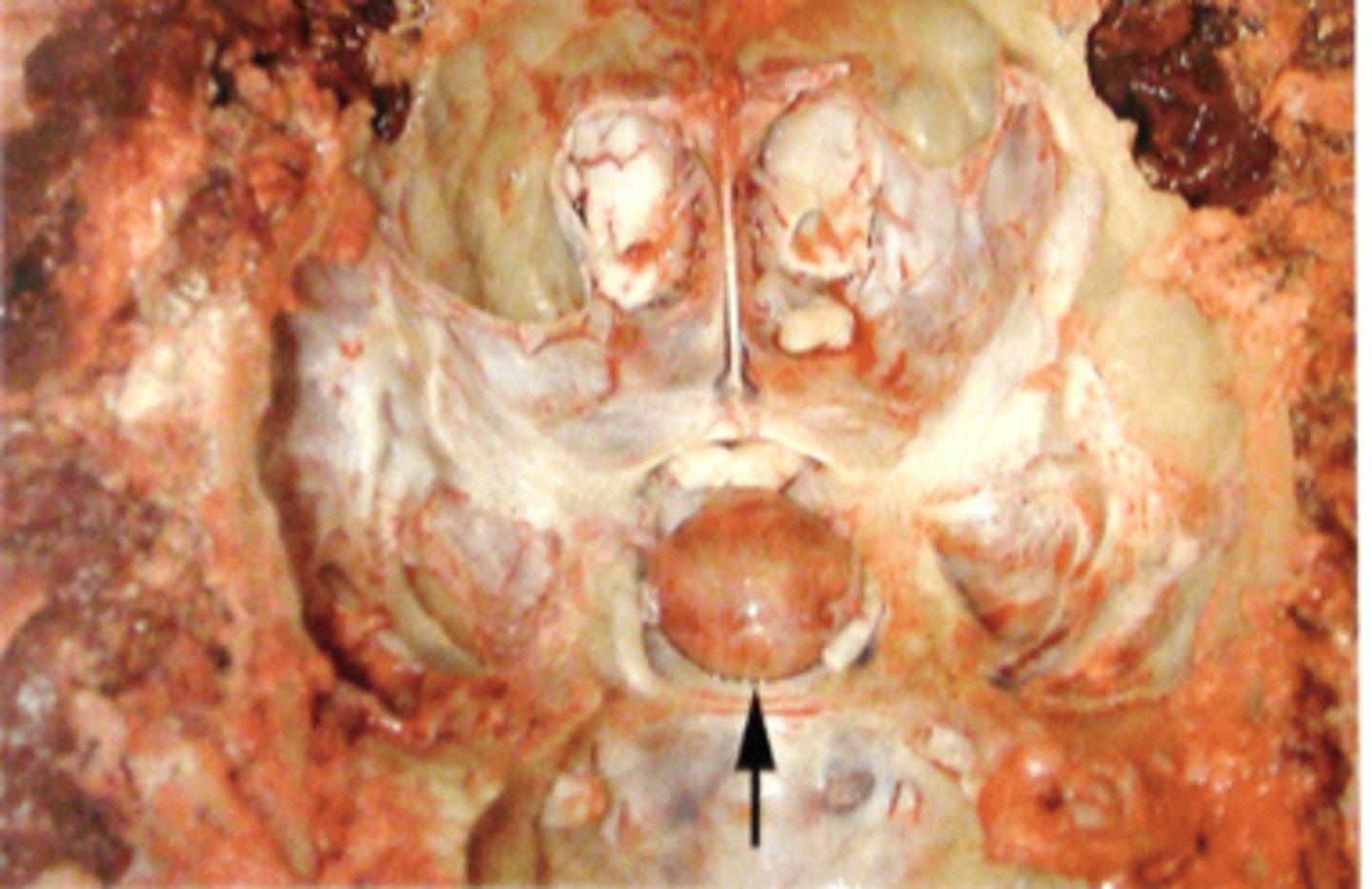 <p>Hypofyse fra hest, hvad er den patoanatomiske diagnose? Se pilen</p>