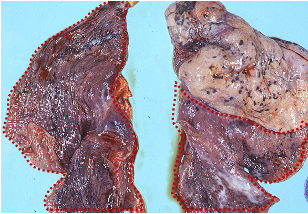 <p>dark red, firm collapsed tissue often lobular and sunken </p>