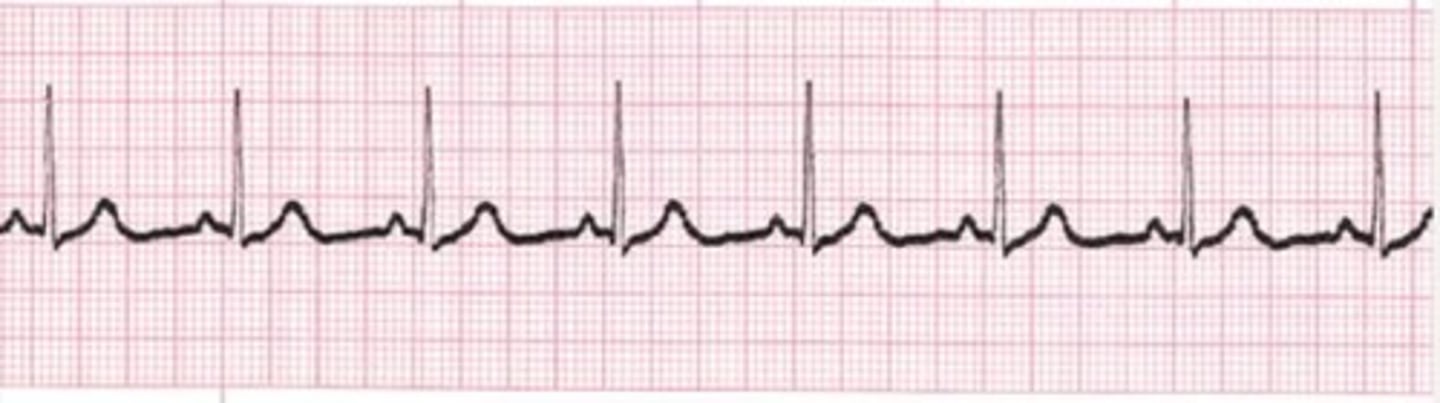 <p>C. 80 beats per minute</p><p>large box is 0.2 sec</p><p>large large box is 1 second</p><p>6 sec - 8 beats</p><p>60 sec - 80 beats</p>