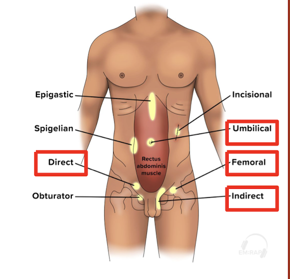 <p><span><strong>protrusion of organ through normally intact wall</strong></span><br><span><strong>-Indirect inguinal (most common), Femoral</strong> (highest rate of incarceration/strangulation)</span></p><p><span>S/S: lump</span><br><span>PE: bulge, auscultation of bowel sounds, inspect the skin for changes (bruising/necrosis is indicator of strangulation)</span></p><p><span>Dx: clinical diagnosis, imaging if concern about complications (US/CT) </span></p><p><span>Tx: </span><span style="color: green"><strong>Reduction</strong></span><span>: </span><span style="color: red"><em>contraindicated if strangulation</em></span></p><p><span style="color: red"><strong>Admission</strong></span><span><strong>: </strong>for observation if incarcerated and reduced/unsuccessful reduction attempts</span><br><span style="color: red"><strong>Operative management</strong></span><span><strong> </strong>for strangulated, closed loop obstruction w/ bowel</span></p>