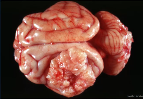 <p>name this tumor</p>