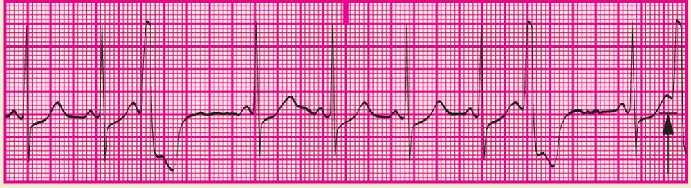 <p>PVC that occurs on the downslope of the T wave or the vulnerable period of the relative ventricular refractory period</p>