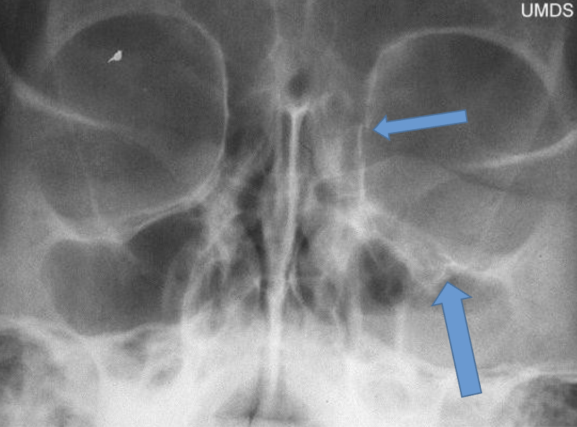 <p>What kind of fracture is this?</p>