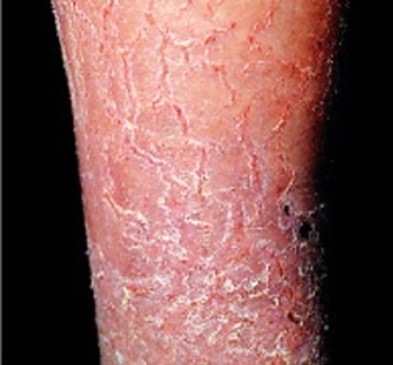 <p>Dry, flaky, dead skin</p><p>Cause:</p><p>-Venous stasis</p><p>-Edema</p><p>Note: lotion (it might snow)</p>