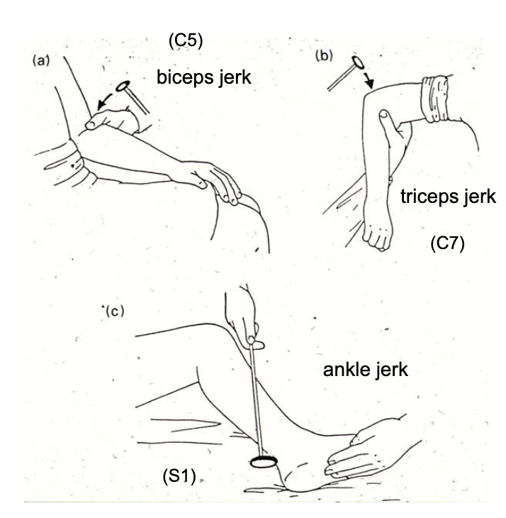 <p>diminished reflexes during deep tendon reflex testing is a sign of…?</p>