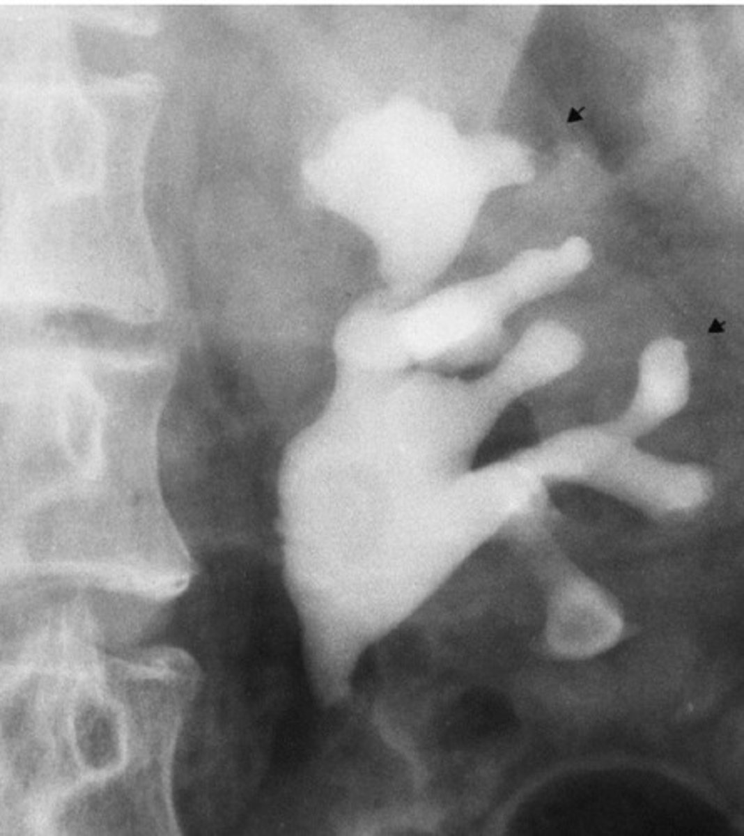 <p>What refers to kidney and renal pelvis inflammation caused by pyogenic bacteria that results in the clubbing of the calyces and thinning of the parenchyma?</p>