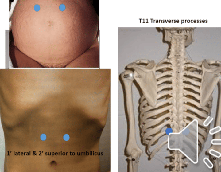 <p>anterior point: 1" lateral and 2" superior to umbilicus<br>posterior point: T11 transverse point</p>