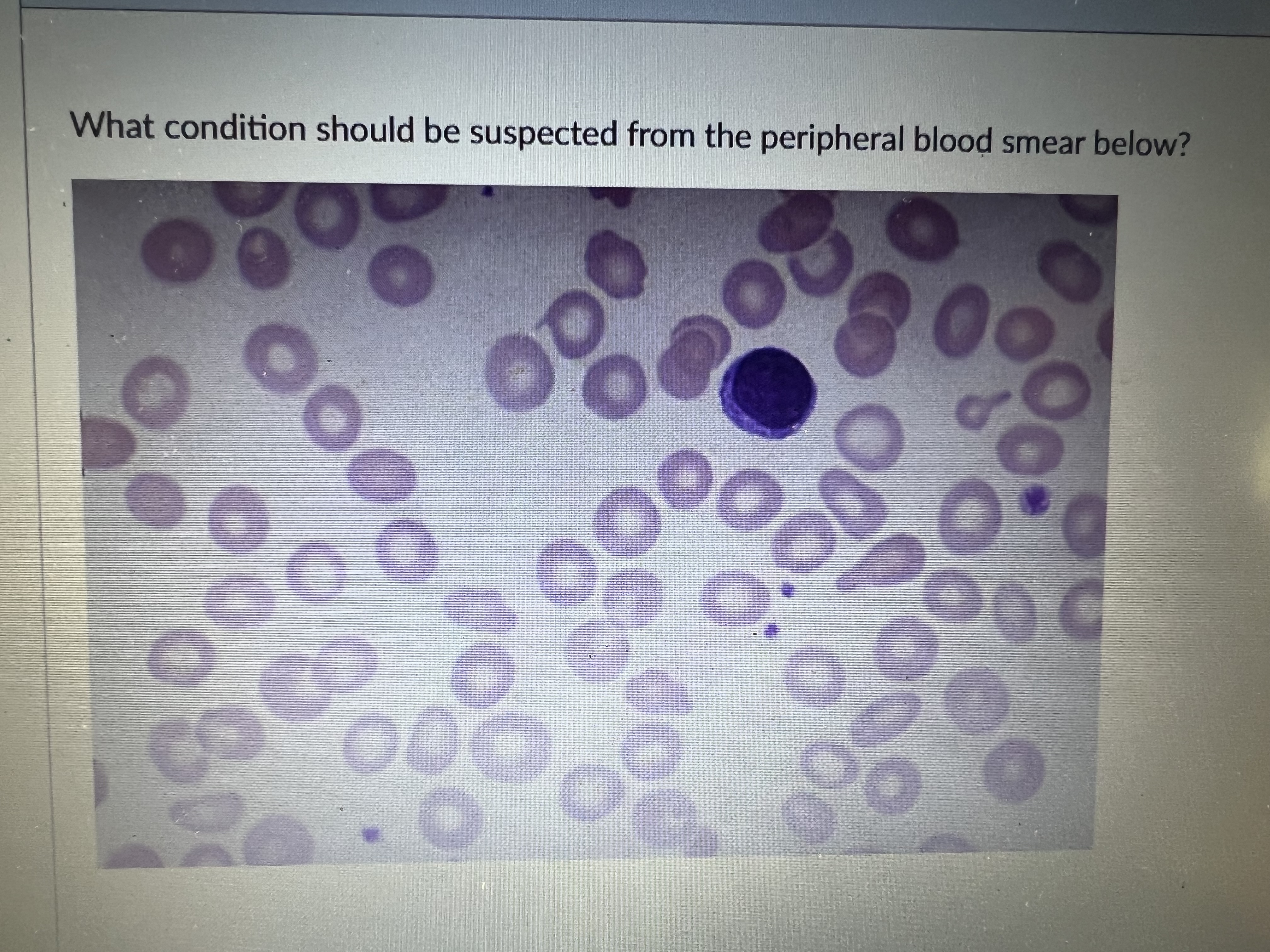 <p>what conditions should be suspected from the peripheral blood smear</p>