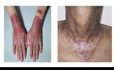 <p>dry, erythematous, sharply-demarcated rash</p><p>diarrhea, depressive symptoms</p>