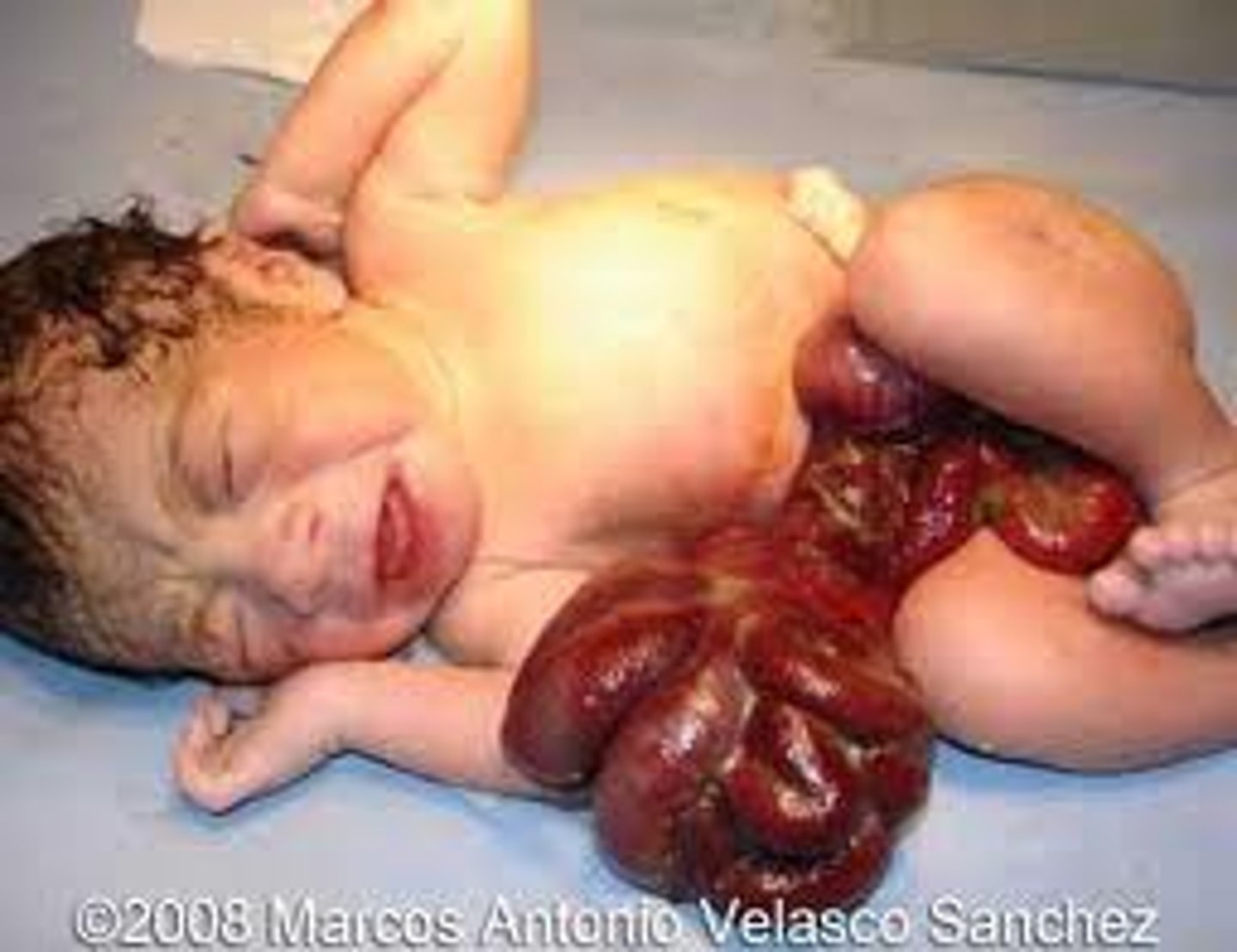 <p>Define Condition:</p><p>Congenital defect with hole in abdominal wall LATERAL TO UMBILICUS --&gt; extrusion of abdominal contents to the RIGHT side</p><p>-Hx:</p><p>&gt; PRENATAL</p><p>&gt; No underlying genetic syndrome</p><p>-Path: Failure of the two lateral folds at 6 weeks gestation to fuse in the midline may result in an abdominal wall defect</p><p>-Sx/PE:</p><p>&gt; Malrotation</p><p>&gt; Atresia</p><p>&gt; Obstruction</p><p>&gt; Perforation</p><p>-Dx: ROUTINE PRENATAL US @ 20 wks gestation</p><p>-Tx: Surgery to push contents back into cavity &amp; close cavity + Treat other issues</p>