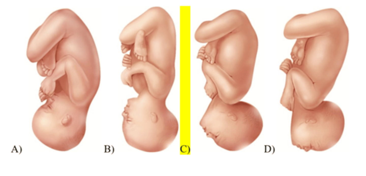 <p>37) A laboring patient is attempting a vaginal birth. An episiotomy has already been performed and the healthcare provider is prepared to extend the episiotomy if necessary. What is this fetus's most likely presentation?</p>