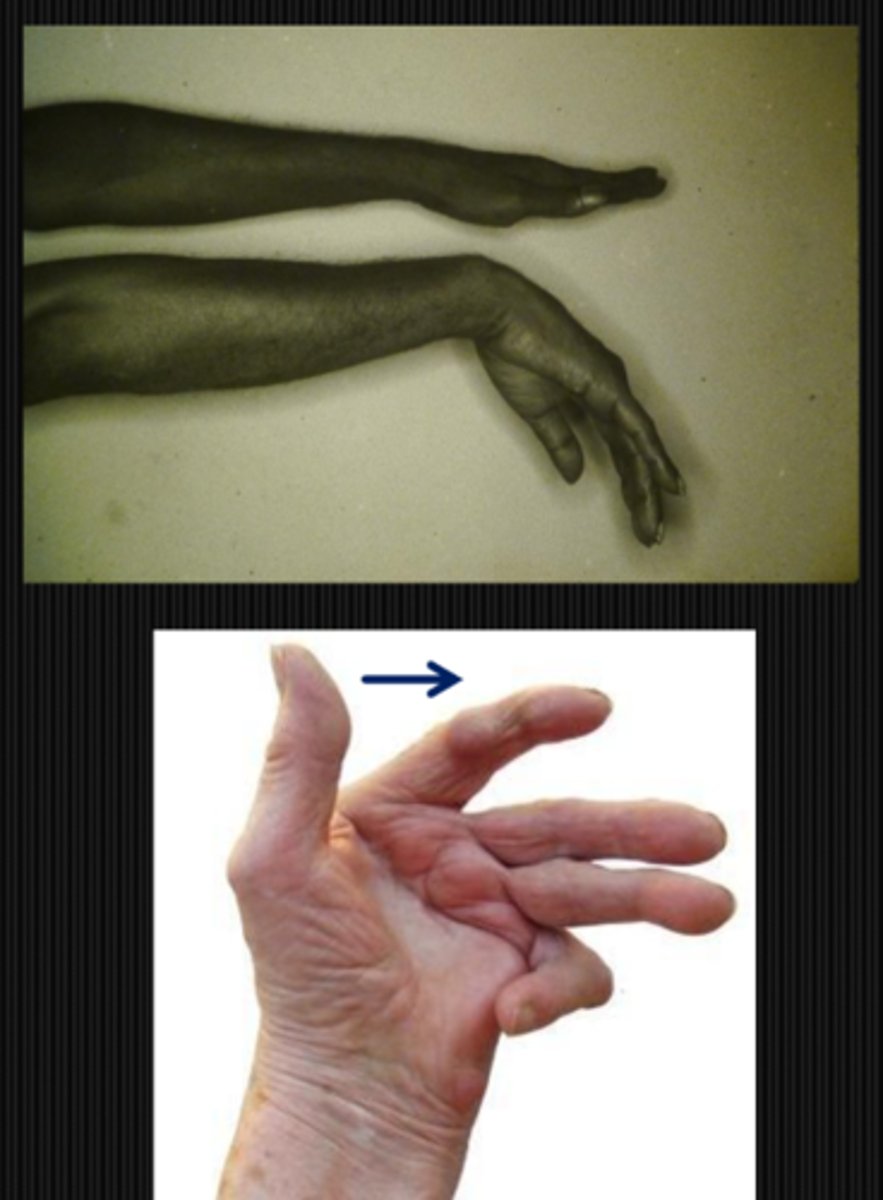<p>wrist drop w/ optic neuropathy and decreased VA = pt may have a radial nerve palsy associated with lead, arsenic, alcohol poisoning</p><p>ulnar deviation = fingers deviated towards ulna in rheumatoid arthritis</p><p>acromegaly </p>