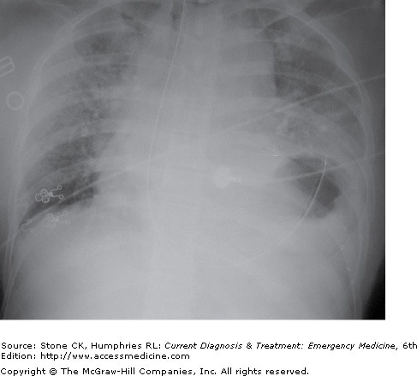 <p>The Correct Answer is: B</p><p>Diaphragmatic rupture is often the result of direct injury to the diaphragm or increased intra-abdominal or intrathoracic pressure. Patient symptoms are often the result of impaired lung expansion and decreased oxygenation. Additional symptoms may include bowel obstruction or other nonspecific bowel complaints. The chest x-ray shows elevation and irregularity of the left diaphragmatic border, with decreased left lung volume. Also of note is a widened mediastinum, which may suggest additional injury, including to the aorta. Lung markings extend through the lung space, which is not consistent with a hemothorax or pneumothorax. Evaluation for a pericardial effusion and/or pericarditis should be performed on this patient, based on the history, with evaluation including echocardiography and EKG. The typical x-ray result for pericardial effusion is termed a "water bottle" heart. However, this would be difficult to assess in the setting of a diaphragmatic rupture. Cor pulmonale is not associated with trauma, and is due to lung disease or pulmonary vascular disease.</p>