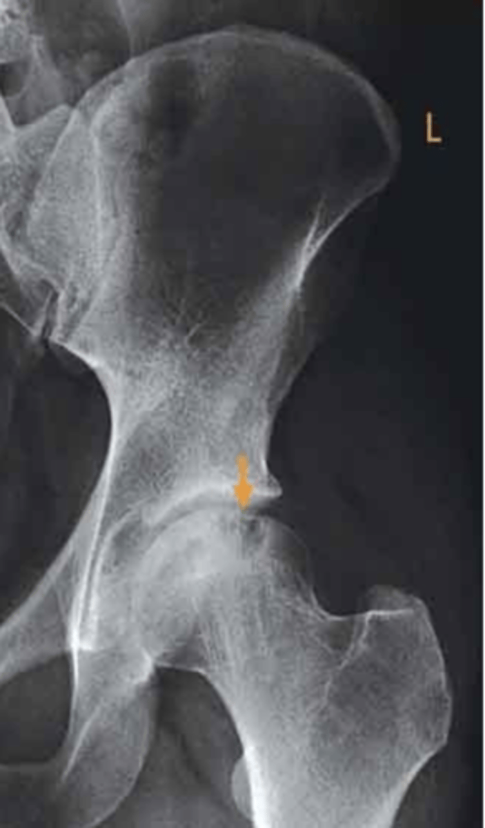 <p>osteochondral fracture of the left femoral head</p><p>3 multiple choice options</p>