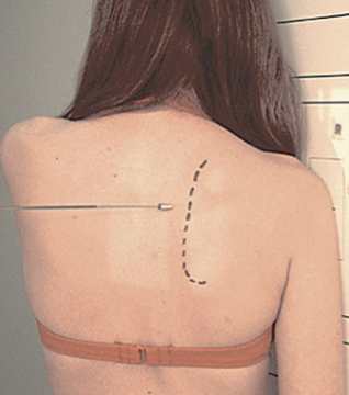 <p>Scapular Y view </p><ul><li><p><span>PA with affected side towards IR</span></p></li><li><p><span>Oblique shoulder 30° - 45° towards&nbsp;IR</span></p></li></ul><p></p>