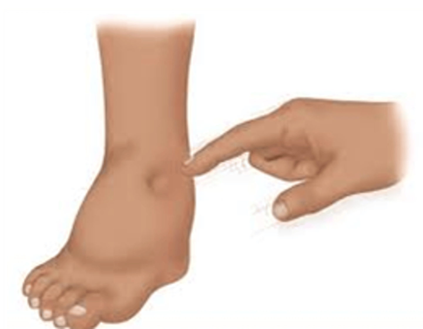 <p>skin dents with pressure (pitting)</p>