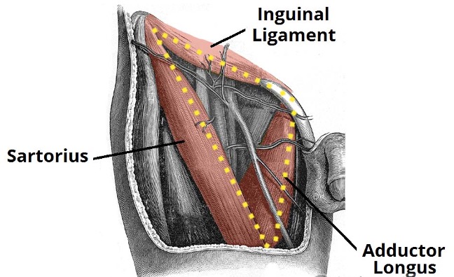 <p><mark data-color="red">inguinal ligament superiorly forms base</mark></p><p><mark data-color="red">sartorius m. laterally</mark></p><p><mark data-color="red">adductor longus m. medially</mark></p>