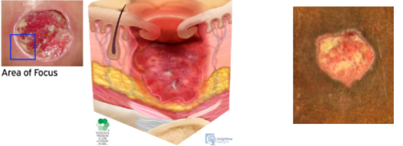 <ul><li><p>full thickness loss of skin</p></li><li><p>adipose is visible</p></li><li><p>granulation tissue and epibole (rolled wound edges) often present</p></li></ul><p></p>