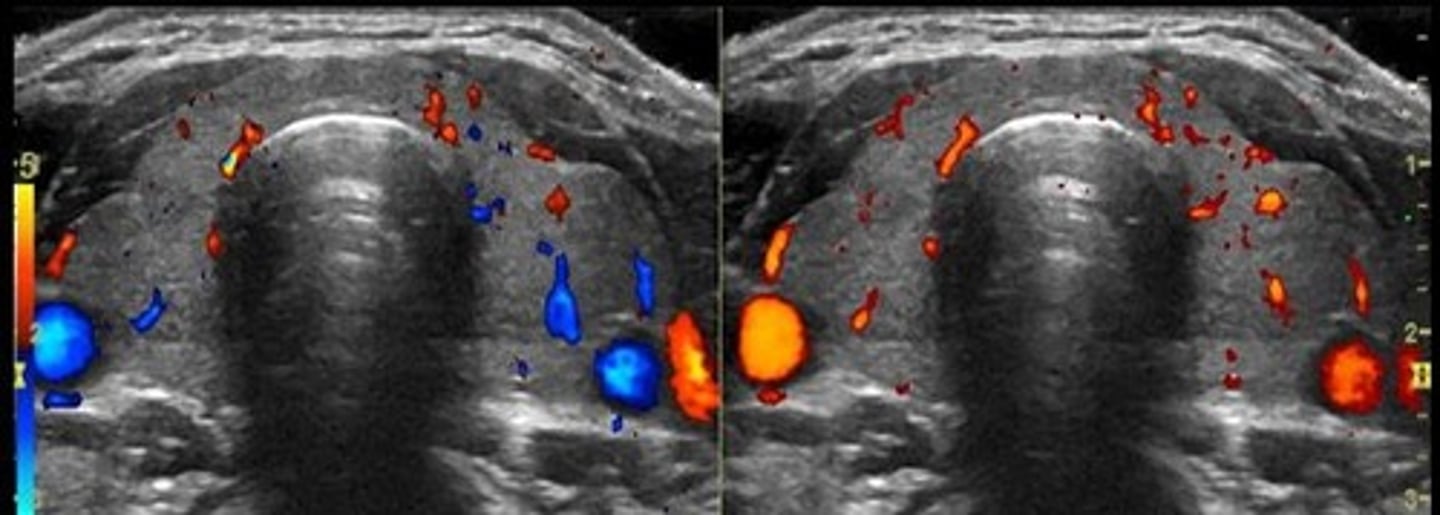 <p>Enlarged, inhomogeneous gland with increased vascularity, especially in overactive cases.</p>