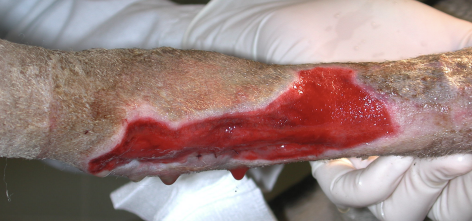 <p><span>Every time the dressing is changed/replaced, sterile aseptic technique should be used.&nbsp;</span><br><br><span>Repeat debridement and lavage. Bandage changes should be done more frequently in the beginning, especially for Type II open fractures.</span></p>