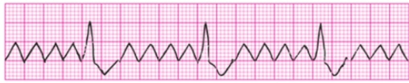 <p>Atrial rate 250-350 varies with conduction ratio, regularity depends on conduction ratio, P waves absent and replaced with zigzag flutter waves, absent PR but present and normal QRS int</p>