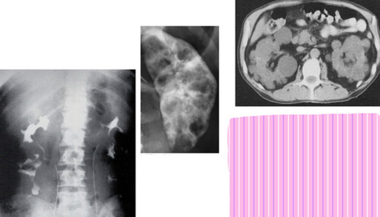 <p>- What is the inherited disorder in which multiple cysts cause lobulated kidney enlargements and renal impairment?</p><p>- How many patients develop liver cysts?</p><p>- What percent of patients develop a berry (brain) aneurysm?</p><p>- How long can patients be asymptomatic for?</p><p>- Is this disorder curable?</p><p>- How does this disorder appear radiographically?</p>