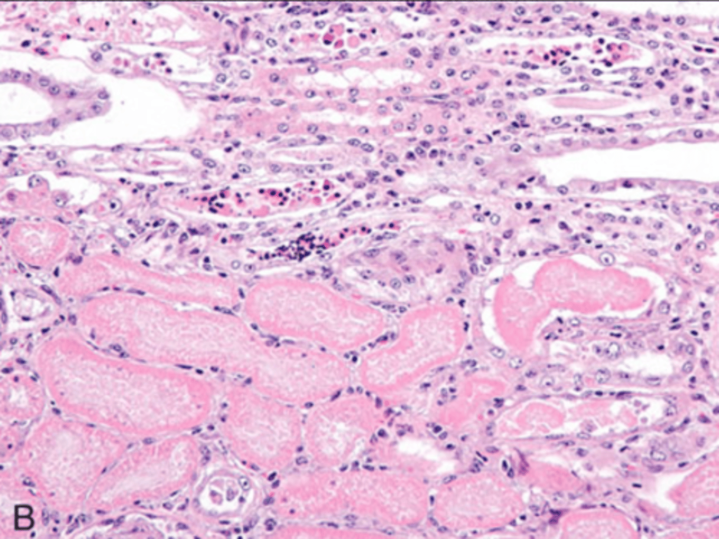 <p>What type of necrosis is being shown in this image?</p>