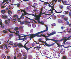 <p>network of reticular fibers in a typical loose ground substance; mesh-like supportive framework</p><ul><li><p>form a framework for soft internal structures; creates network that <strong>supports attachment of other cell types like white blood cells</strong>, mast cells, and macrophages</p></li><li><p>located in lymphoid organs, <strong>lymph nodes</strong>, bone marrow and spleen</p></li><li><p>Looks kind of like a cherry blossom tree in most images — reticular fibers are the wood</p></li></ul><p></p>