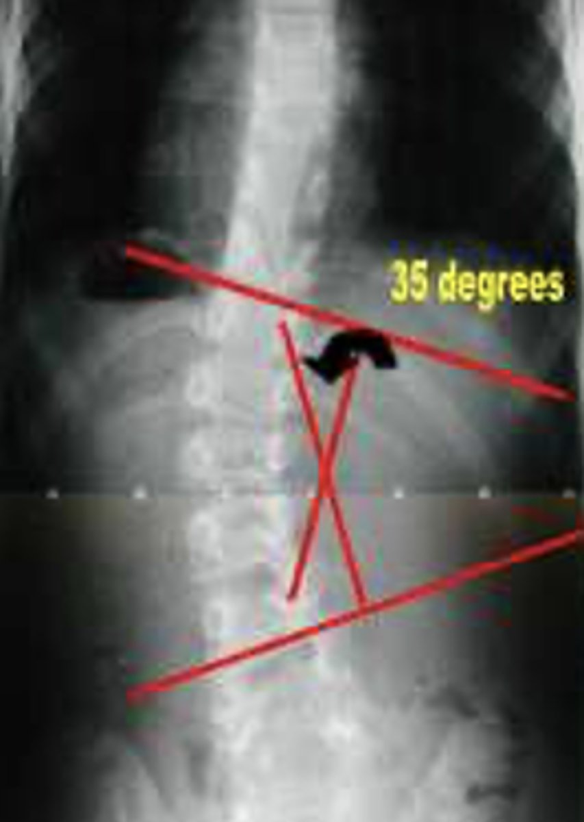<p>Measured to define scoliosis. > 10° is needed for dx.</p>