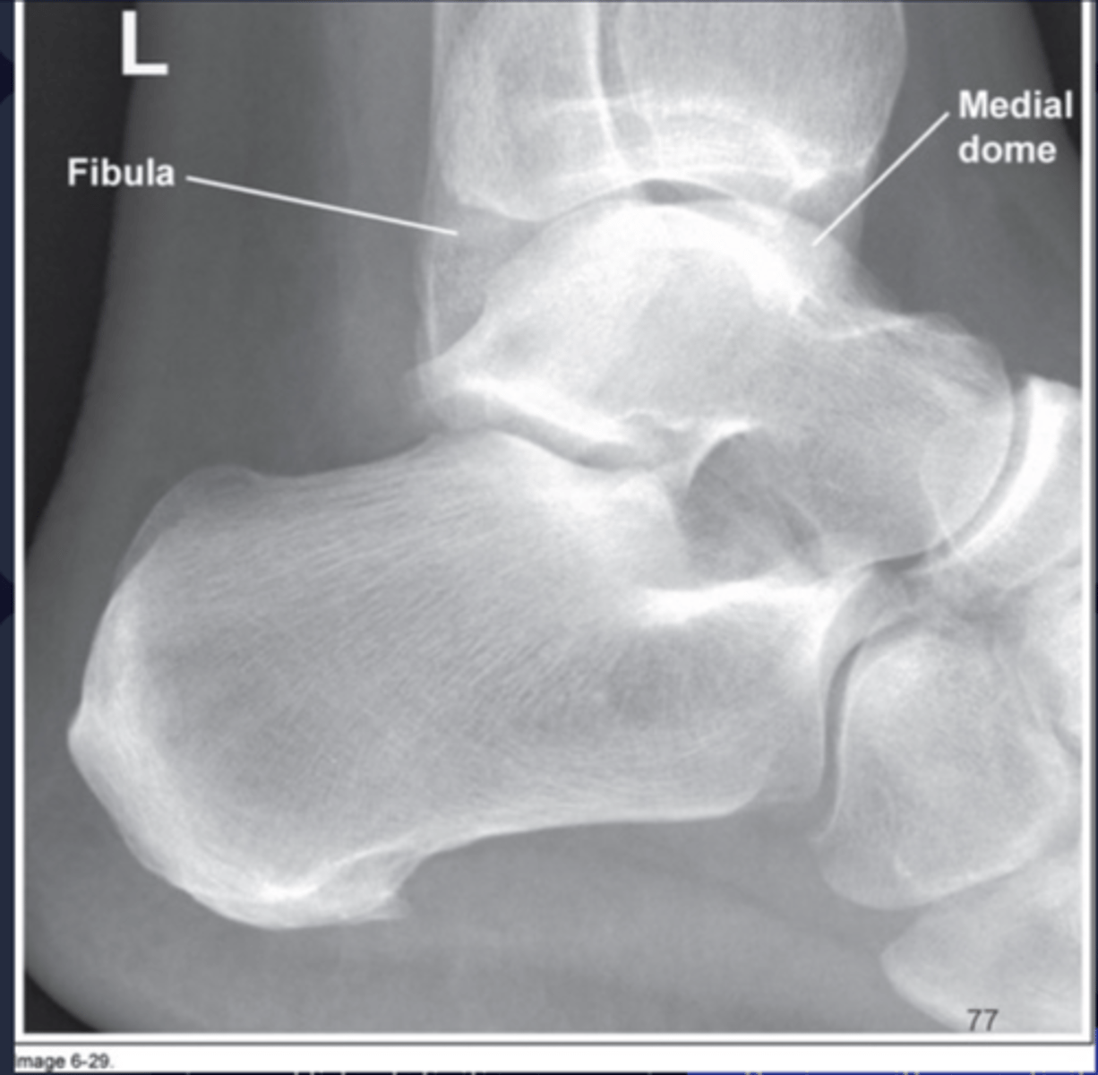 <p>Heel was elevated</p>