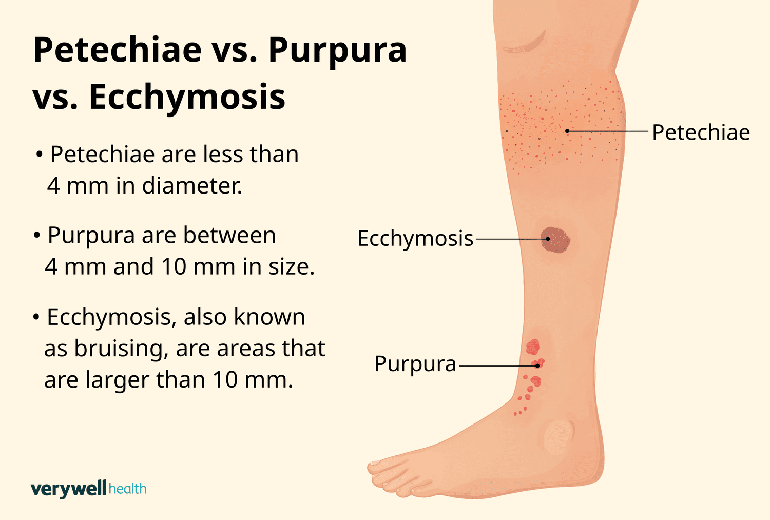 <p>PP: hemorrhagic lesions</p><p>E: bleeding in skin<br>bleeding in small blood vessels</p><p>CM:<br><u>petechiae:</u><br>pinpoint macules<br>1-2 mm in size</p><p><u>ecchymosis:</u><br>bruise<br>larger</p>