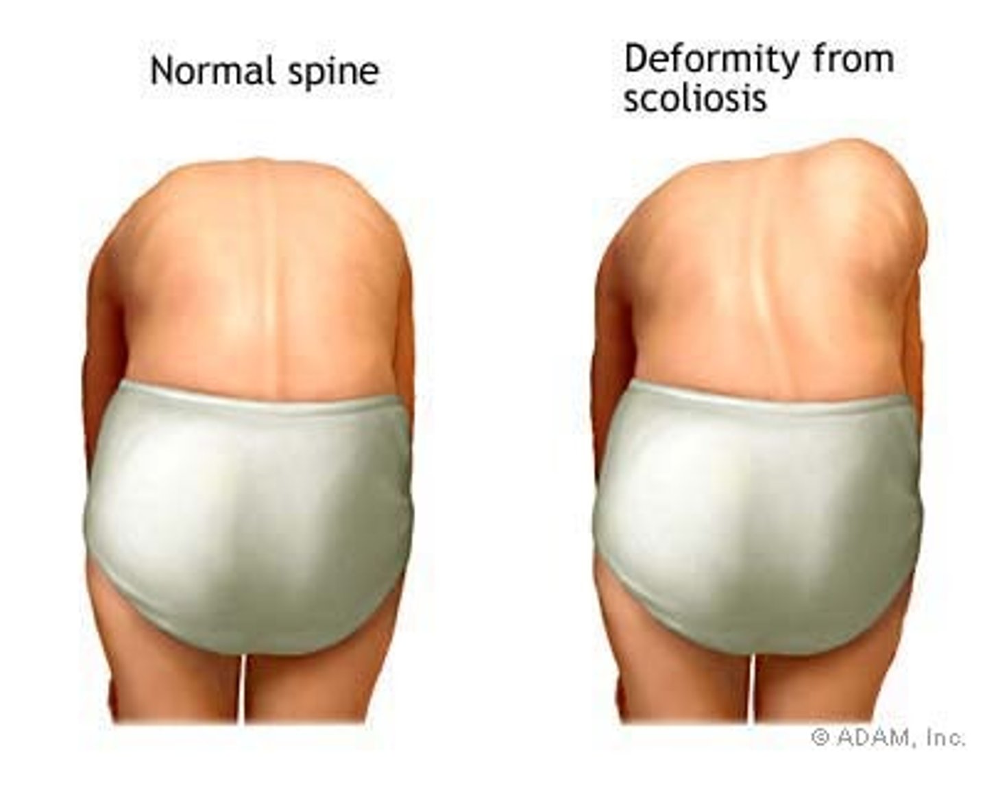<p>patient stands &amp; bends forward, keeping the knees straight &amp; hangs arms loosely towards the floor</p><p>- assess the patient from behind for thoracic/lumbar prominence or "rib hump"</p>