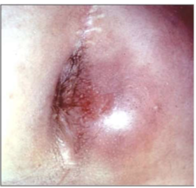 <p>35 y/o male presents to the ER for severe constant pain that leaves him unable to sit down. He also reports muscle aches. Vitals are stable with the exception of a temp 102. On a physical exam erythematous area induration around the anus with fluctuance on DRE. What do you want to do besides go home?</p>