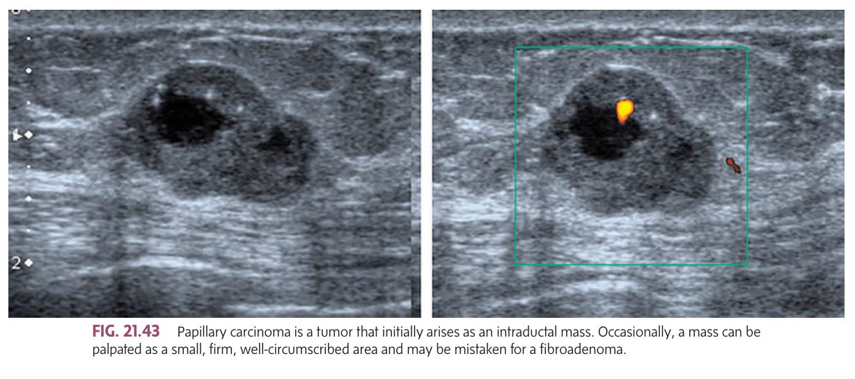 <p class="">A tumor that initially arises as an intraductal mass; may also present as an intracystic tumor (rare). Early stage is noninvasive and may develop from a benign ductal papilloma. Associated with little fibrotic reaction.</p><p class=""><strong>Signs &amp; Symptoms:</strong></p><ul><li><p class="">Earliest sign: <strong>bloody nipple discharge</strong></p></li><li><p class="">Sometimes a <strong>small, firm, well-circumscribed mass</strong> (may mimic fibroadenoma)</p></li><li><p class="">May show <strong>blue or red discoloration under the skin</strong> with <strong>central ulceration</strong></p></li><li><p class="">A <strong>diffusely nodular skin appearance</strong> may indicate multiple intraductal papillary carcinomas</p></li><li><p class="">In advanced intracystic form, mass may become <strong>poorly circumscribed</strong></p></li></ul><p class=""><strong>Mammographic Findings:</strong></p><ul><li><p class=""><strong>Microcalcifications</strong></p></li><li><p class=""><strong>Clustered nodules</strong> in a single quadrant</p></li></ul><p class=""><strong>Other Notes:</strong></p><ul><li><p class="">Malignant lesions extend &gt;1.5 cm into a duct and its branches</p></li><li><p class=""><strong>Prognosis is more favorable</strong> than other types</p></li></ul><p></p>