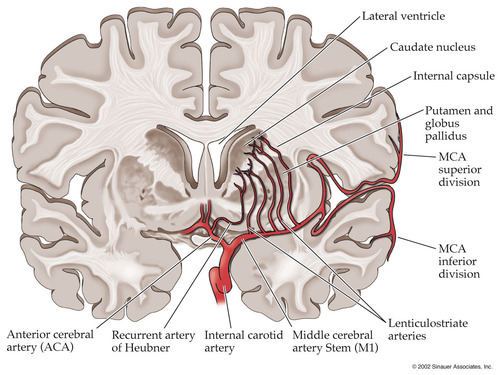 <p>small, deep penetrating arteries that branch from the middle cerebral artery, very thin and vulnerable to strokes</p>