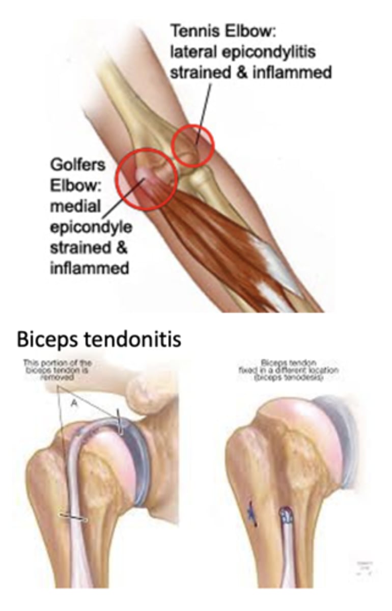 <p>Inflammation of a tendon where it attaches to or contacts a bone</p><p>Causes: Repetitive motion/overuse</p><p>Symptoms:</p><p>- Pain</p><p>- Tenderness</p><p>- Weakness</p><p>Treatments:</p><p>- Rest</p><p>- Occupational therapy &amp;/or PT</p><p>Bracing and exercise</p><p>- Anti-inflammatory medications</p><p>- Surgery in severe cases (tears)</p>