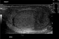 <p>infection of the epididymis</p><p>SA: enlargement, hypoechoic gland, increased vascularity</p><p>CI: scrotal pain/ possible discharge</p>