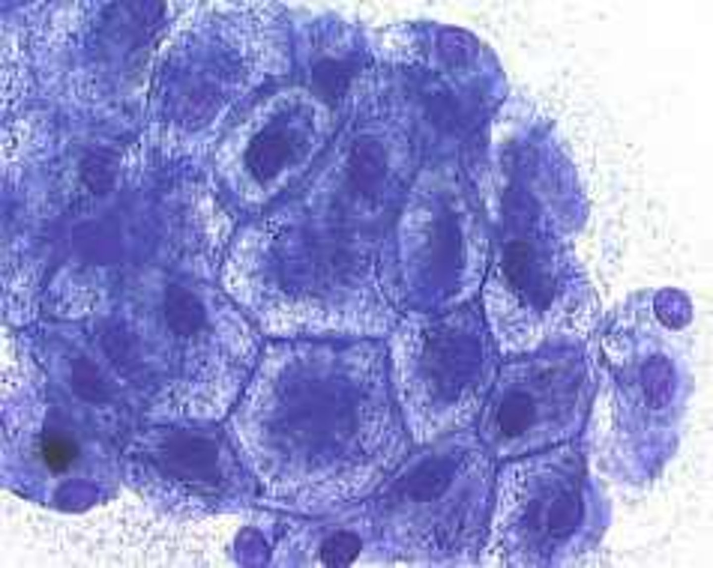 <p>Acanthocytes, potentially due to alterations in cell membrane lipids.</p>