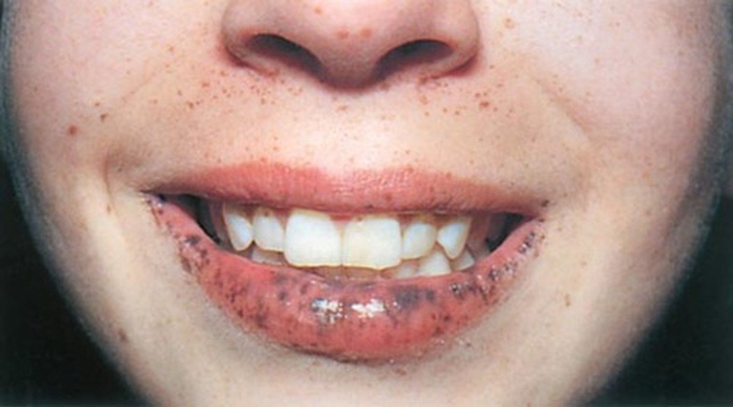 <p>Peutz-Jeghers syndrome</p><p>(inherited, benign polyposis can cause bowel obstruction, increased cancer risk-mainly GI)</p>