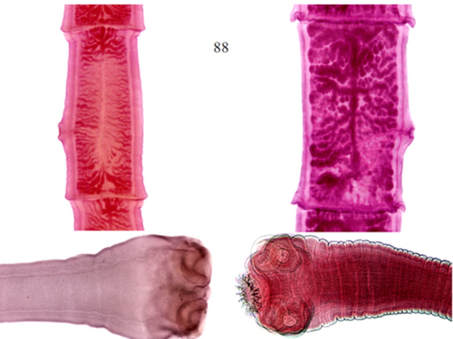 <p>-pork tapeworm</p><p>-raw undercooked pork</p><p>-adult in the small intestine</p><p>-can lead to cysticercosis or neurocysticercosis</p><p>-SOL: 4 suckers, ARMED scolex meaning has hooks!!!!, LESS than 13 lateral uterine branches!!</p><p>-sag looses its hooks!</p><p>-eggs are identical!!!</p><p>-you can differentiate proglottids by INDIA INK</p><p>*inject into lateral genital pore</p><p>*count # of primary lateral uterine branches on 1 side of the uterine stem (<13 here)</p><p>-if you eat infected meat with larvae, you'll get adult tapeworm in gut</p><p>-if you eat the eggs you'll get the larvae which creates cysticercosis</p><p>SUM:</p><p>-taeniasis and cysticercosis</p><p>-pork tapeworm (under cooked pork)</p><p>EAT INFECTED MEAT: get taeniasis</p><p>EAT EGGS: get cysticercosis</p>