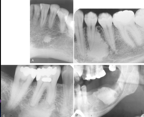 <p>-a focus of increased radiopacity of unknown cause</p><p>-not associated with any inflammatory, dysplastic, neoplastic, or systemic disorder</p><p>-peak prevalence in third decade of life- arises in late first and early second decade of life</p><p>-common incidental radiographic finding</p><p>-typical site: mandibular first and second molar region »maxilla</p><p>-periapical dense bone island may externally resorb tooth root (rarely); tooth remains vital and resorption is self-limiting (don’t need endo tx)</p><p>-completely benign</p><p>-slow, gradual growth until skeletal maturity- do not be alarmed by the size at time of diagnosis</p><p>-do not touch!</p><p>-homogenous, well-defined radiopacity with no radiolucent ring against adjacent normal cancellous bone</p>