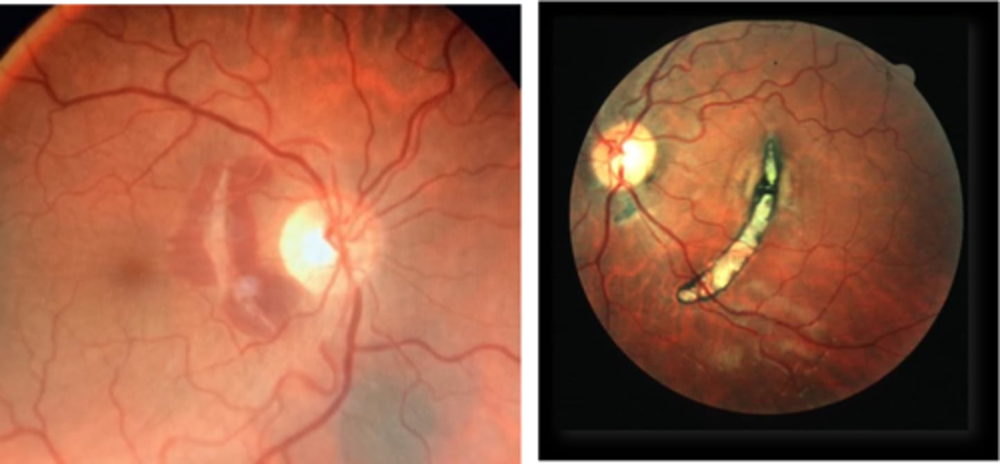 <p>curvilinear or crescent-shaped streak, sometimes concentric to ONH</p><p>+/- subretinal /subRPE hemorrhage (acute)</p><p>Bruch's/Choriocapillaris/RPE damage</p><p>overlying neurosensory retina is intact</p><p>+/- RPE hyperplasia (chronic)</p><p>+/- CNV over time</p>