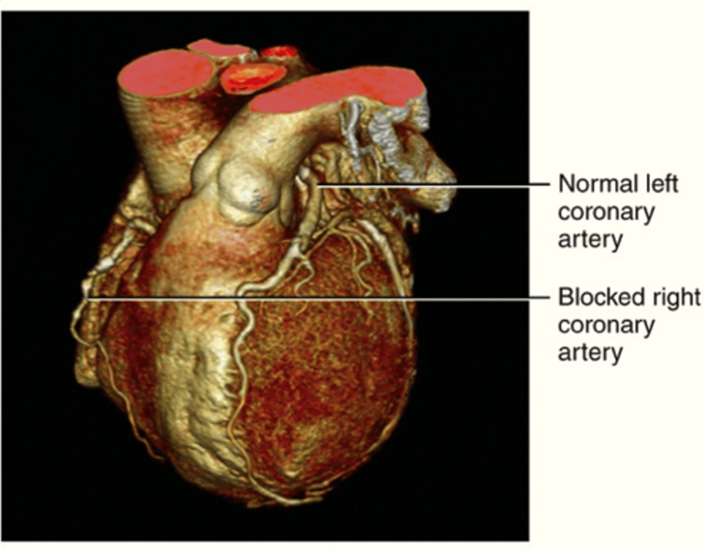<p>A contrast medium is injected into a vein, numerous x-ray beams use to look at the heart which is used to study the blood vessels and check for any coronary artery blockages</p>