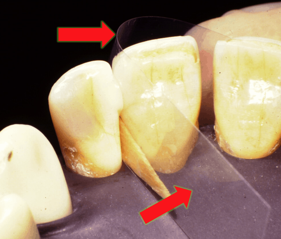 <p>Placed in anterior area</p>