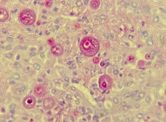 <p><span style="font-family: &quot;Times New Roman&quot;, serif; line-height: 107%;"><span>Clinical association: NA dogs with coccidiodomycosis will have a history of travel to western USA or Mexico where this species is endemic</span></span></p><p class="MsoListParagraphCxSpMiddle"><span style="font-family: &quot;Times New Roman&quot;, serif; line-height: 107%;"><span>This stain is from a lung preparation from a dog</span></span></p><p class="MsoListParagraphCxSpMiddle"><span style="font-family: &quot;Times New Roman&quot;, serif; line-height: 107%;"><span>Has two forms – mould or yeast (aka thermally dimorphic fungi)</span></span></p><p class="MsoListParagraphCxSpMiddle"><span style="font-family: &quot;Times New Roman&quot;, serif; line-height: 107%;"><span>Mould form (25C): septate hyphae</span></span></p><p class="MsoListParagraphCxSpMiddle"><span style="font-family: &quot;Times New Roman&quot;, serif; line-height: 107%;"><span>Yeast/Spherule form (37C): huge spherules with endospores</span></span></p><p class="MsoListParagraphCxSpMiddle"><span style="font-family: &quot;Times New Roman&quot;, serif; line-height: 107%;"><span>What is it?</span></span></p>