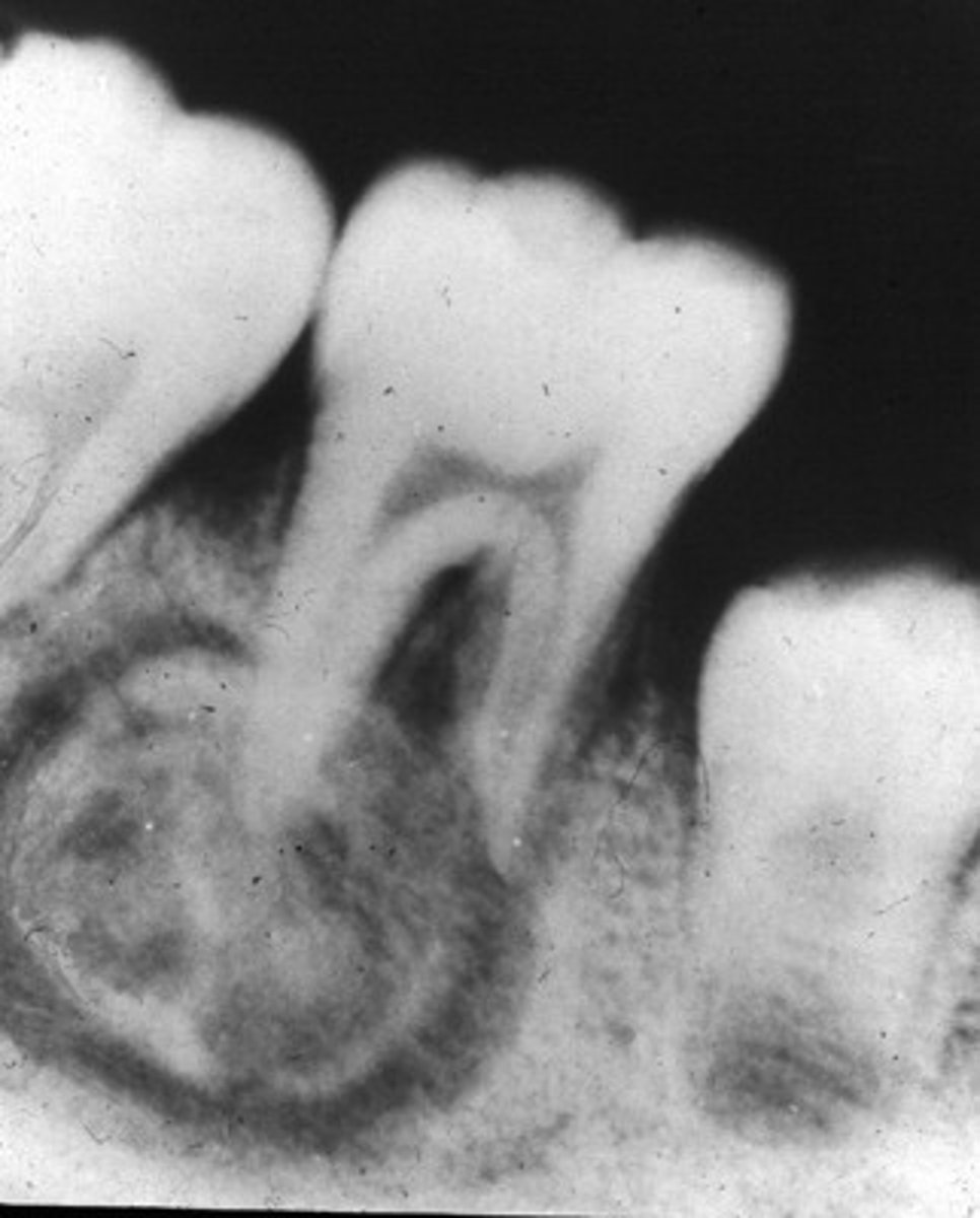 <p>common locations: mand 1st molar</p><p>clinical features: it presents w pain </p><p>radiographic: it is a dense radiopaque mass that binds w the apex; it is a sclerotic mass w a thin radiolucent rim; vital teeth are involved</p><p>population: children + YA <30s</p>