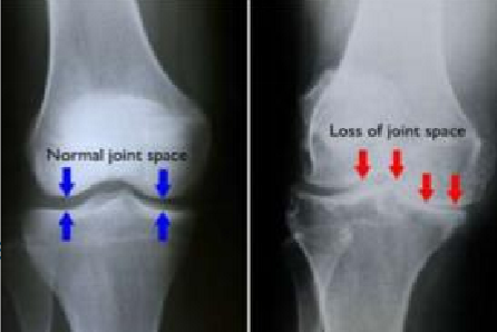 <p>disease of a joint that invariably leads to joint space narrowing &amp; changes to the bones of both sides of the joint&nbsp;</p><ul><li><p>can be divided into&nbsp;</p><ul><li><p><span style="color: red;"><strong>hypertoric</strong></span></p></li><li><p><span style="color: red;"><strong>erosive (inflammatory)</strong></span></p></li><li><p><span style="color: red;"><strong>infectious</strong></span></p></li></ul></li></ul><p></p>